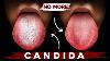 A Better Way To Eliminate Candida For Good